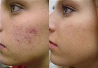 7-must-know-tips-about-acne-treatment