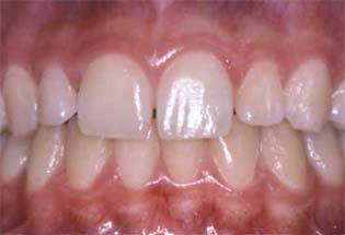 Healthy+gums+images